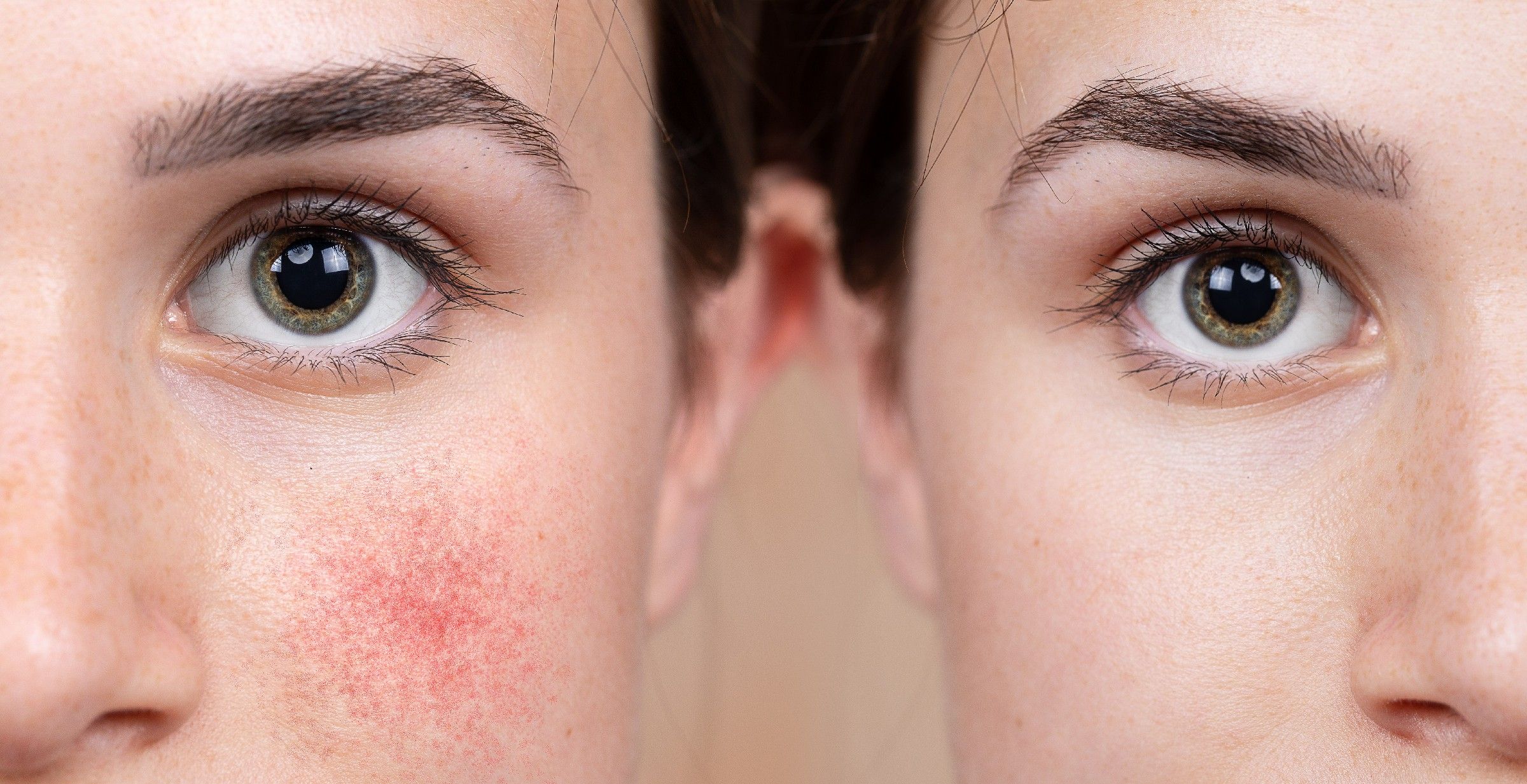 Egy makacs bőrprobléma: a rosacea
